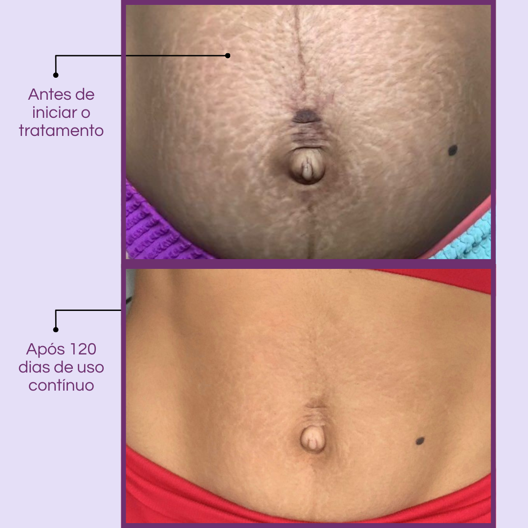 Daily Tratamento - Creme Para Estrias